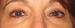 before after eyelid surgery blepharoplasty