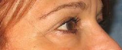 before after eyelid surgery blepharoplasty