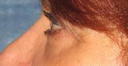 before after eyelid surgery blepharoplasty