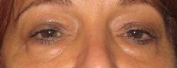 before after eyelid surgery blepharoplasty