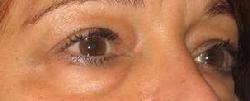 before after eyelid surgery blepharoplasty