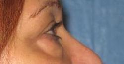 before after eyelid surgery blepharoplasty