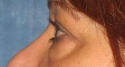 before after eyelid surgery blepharoplasty