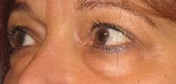 before after eyelid surgery blepharoplasty