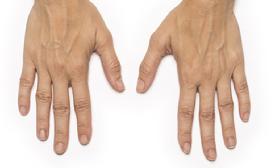 before/after radiesse hands