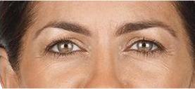 before/after xeomin