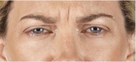 before/after xeomin