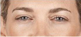 before/after xeomin