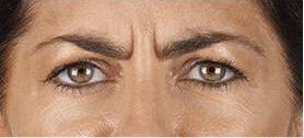 before/after xeomin