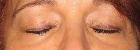 before after eyelid surgery blepharoplasty