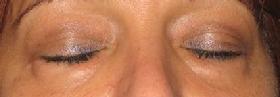 before after eyelid surgery blepharoplasty