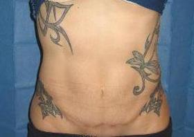 before after mini tummy tuck abdominoplasty