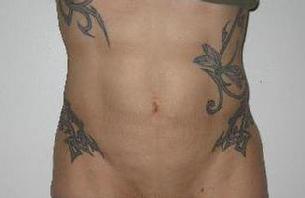 before after mini tummy tuck abdominoplasty