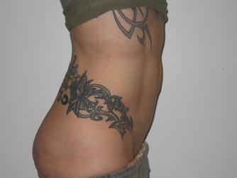 before after mini tummy tuck abdominoplasty