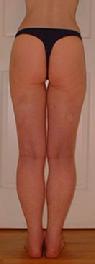 before after liposuction thighs